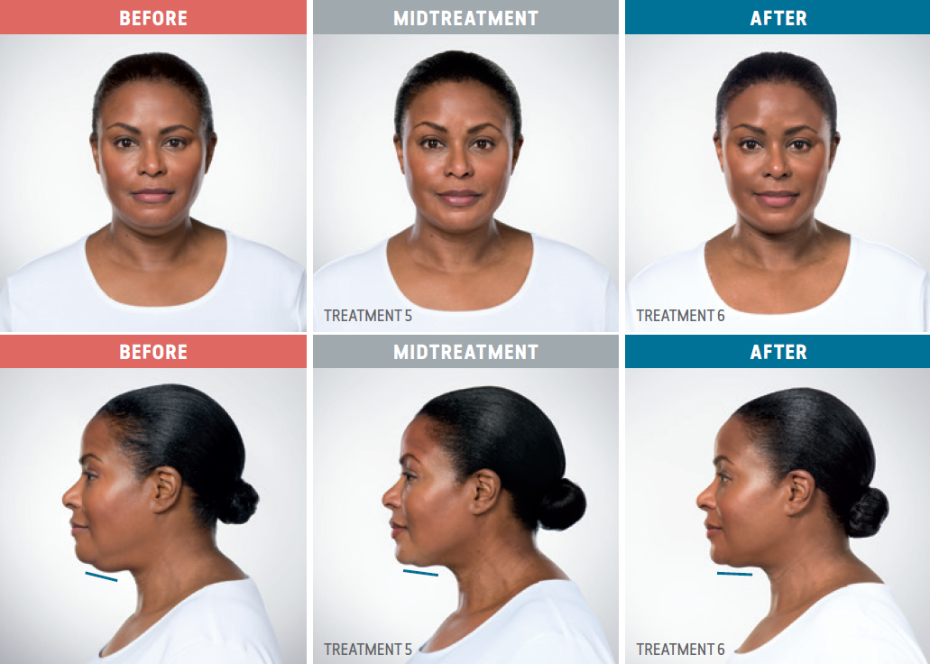 Female African American patient comparison photos from before, during, and after treatment