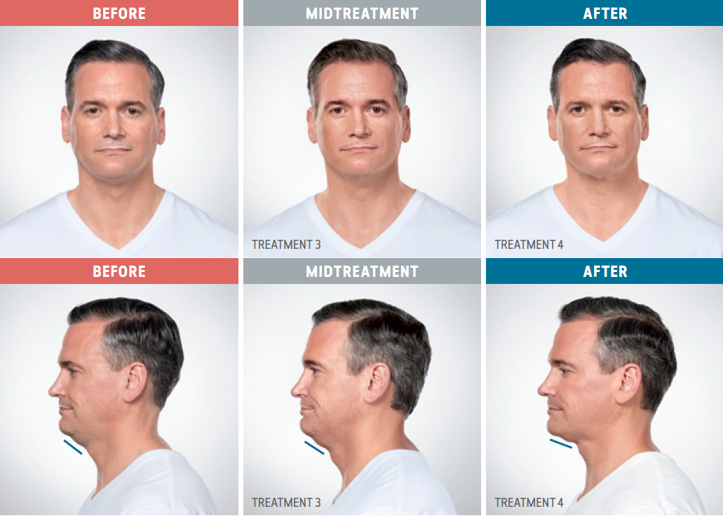 Caucasian male patient comparison photos from before, during, and after treatment