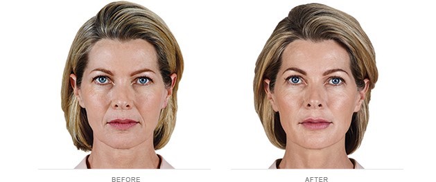 Female patient before and after Juvederm