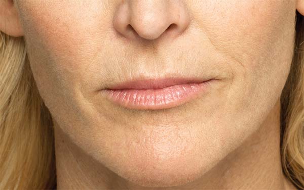 Close-up of female patient's face after treatment