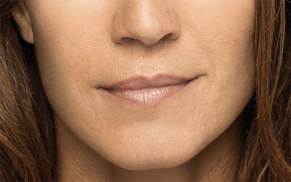 Close-up of second female patient's face after treatment