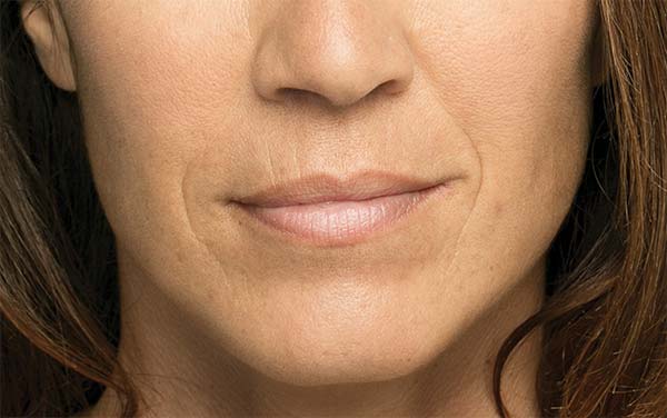 Close-up of second female patient's face before treatment